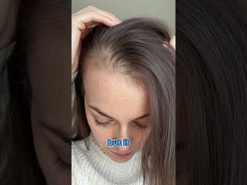 FEMALE HAIR LOSS | GENETICS AND DHT EXPLAINED | TOP SCALP